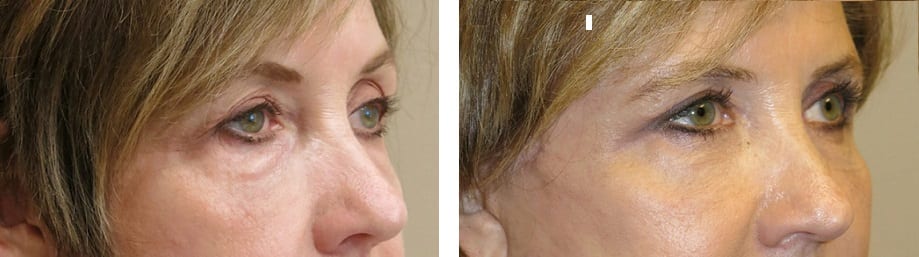 Cirugía de la Mirada caso 1 — antes y después